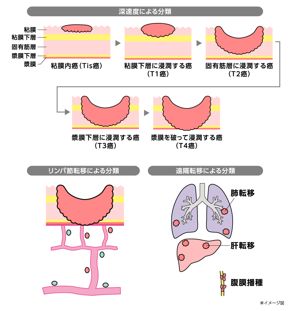 ステージ分類を示す図