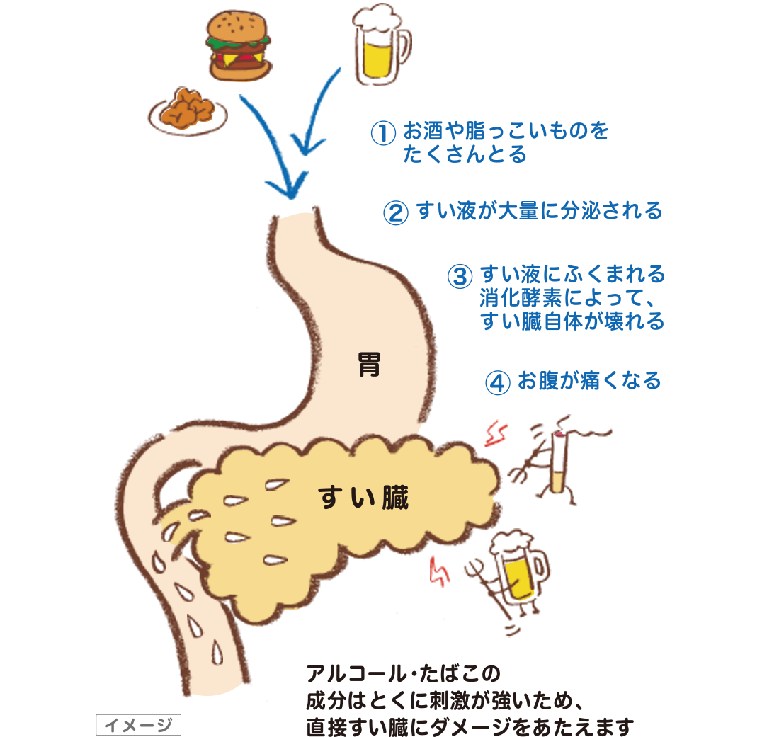 イラスト:慢性すい炎の痛みの原因イメージ