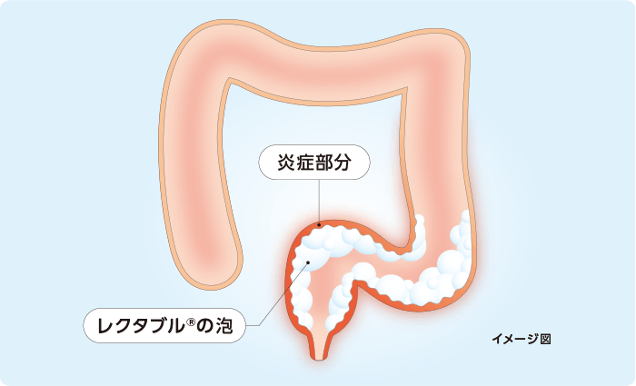 レクタブルⓇ投与後、炎症部分にレクタブルⓇの泡が留まっている様子（イメージ図）