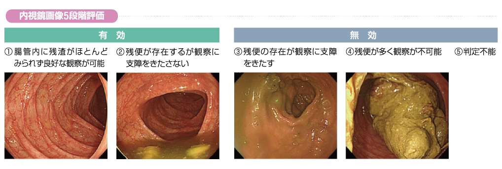 内視鏡画像5段階評価を示す画像
